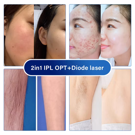 Ice Cool IPL Hair Removal 3 Wave Diode Laser Hair Removal Machine for Sale