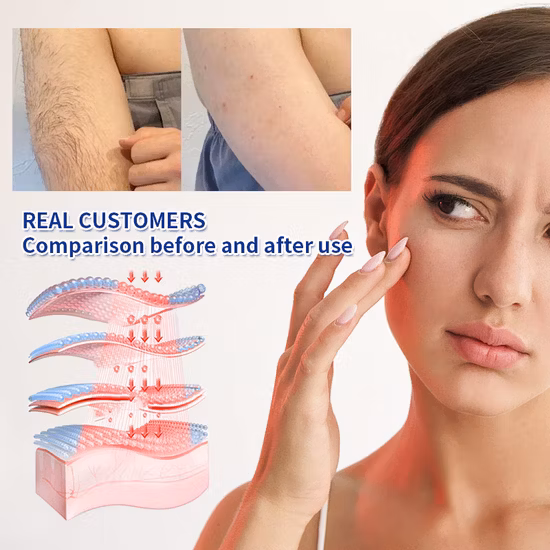 Laser IPL per la depilazione indolore dell'attrezzatura di bellezza di alta qualità ghiacciata